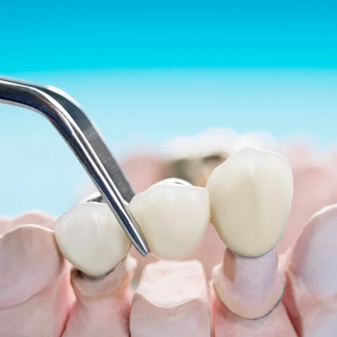 Crowns and Bridges - In-House Lab Case Study